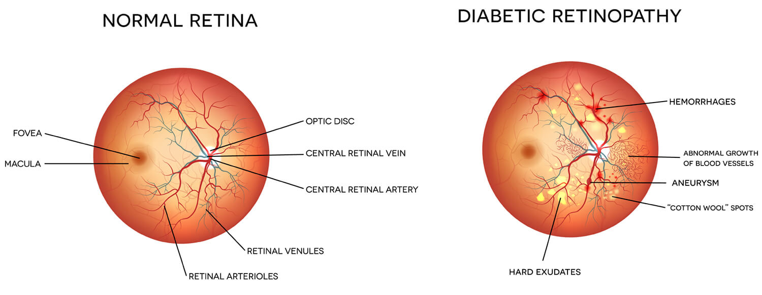 Diabetic Eye Disease Boston | Diabetic Retinopathy Cambridge